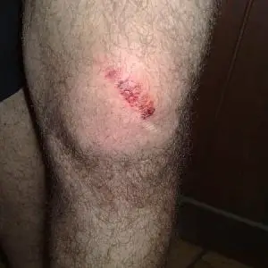 Knee didn't look that bad, but it really hurt inside.