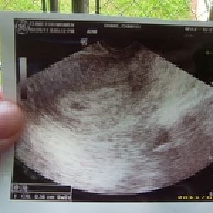 ultrasound 4 26 11   this was my angel that i miscarried on april 28th 2011...RIP MY LOVE! MOMMY LOVES U!