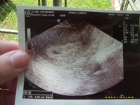 ultrasound 4 26 11   this was my angel that i miscarried on april 28th 2011...RIP MY LOVE! MOMMY LOVES U!